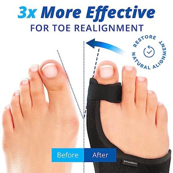 Bunion Correction Kit BUY 1 GET 1 FREE - Picture 4 of 4